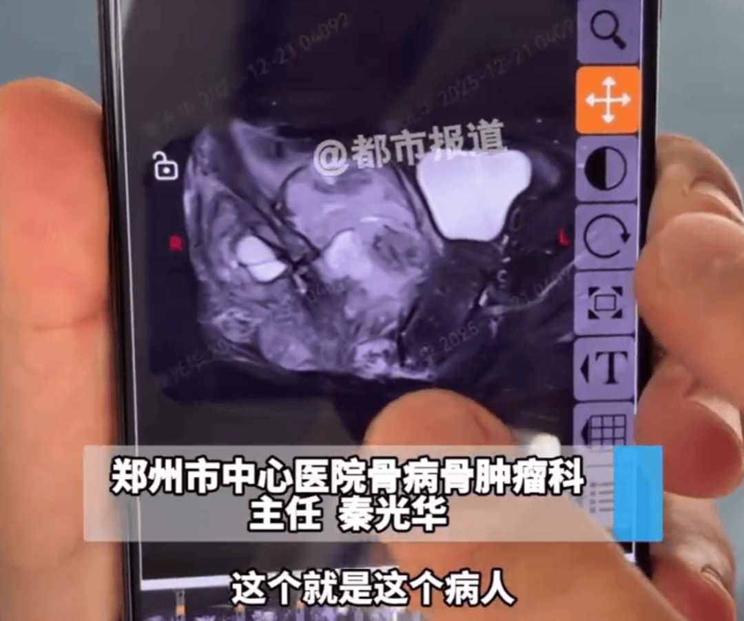 那可恩普拉托姆联vs查英特贺纳比尔
_13岁女孩频繁屁股疼确诊骨癌那可恩普拉托姆联vs查英特贺纳比尔
!或将截掉一侧屁股